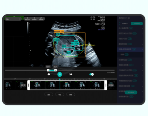 產(chǎn)前動(dòng)態(tài)超聲影像處理系統(tǒng)airiscan t10