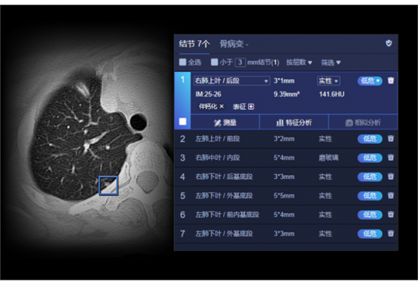 肺結(jié)節(jié)ct圖像輔助檢測(cè)軟件uai-pioneerchest聯(lián)影