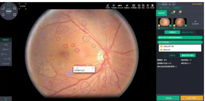 眼底病變眼底圖像輔助診斷軟件ai-100康夫子