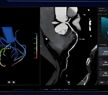 冠脈ct造影圖像血管狹窄輔助評(píng)估軟件