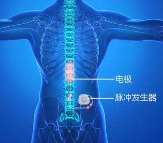  體外脊髓神經刺激測試系統