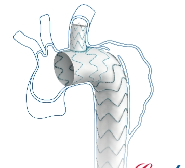  可主動調控胸主動脈覆膜支架系統(tǒng)